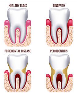 Comparison of healthy gums and those with problems.