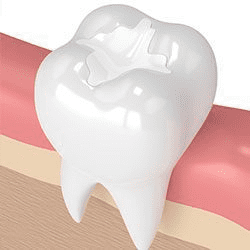 Metal-Free Composite Bonding