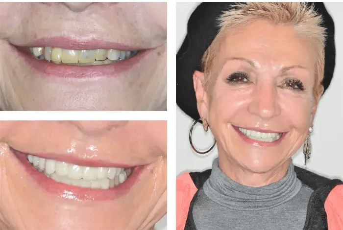 Before and after teeth whitening results in Hollister Family Dental & Implant Center