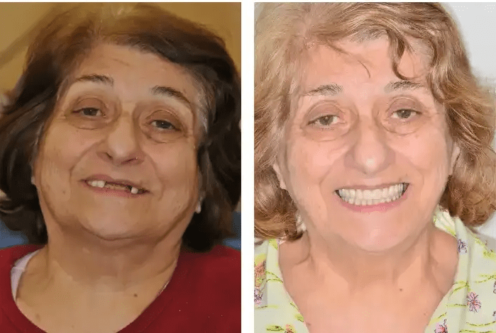 Dentures before and after results in Hollister Family Dental & Implant Center.