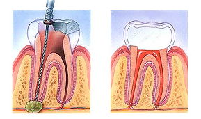 Root Canal Therapy in Hollister, CA.
